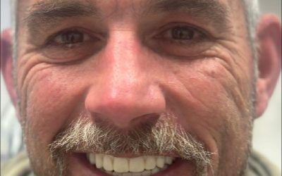 David’s All-on-X Smile Transformation at Norlane Dental