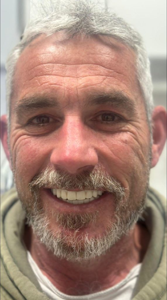 Patient seeing his temporary All-on-X smile for the first time at Norlane Dental in Geelong