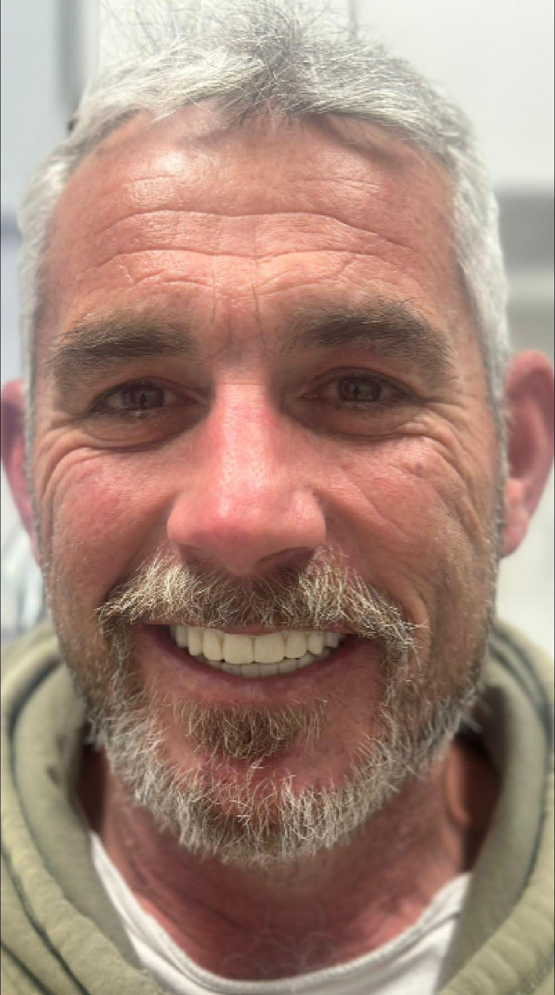Featured image for “David’s All-on-X Smile Transformation at Norlane Dental”