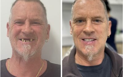 Full Arch Dental Implants Case Study: Upper and Lower All-on-X Rehabilitation by Dr Rashi Gupta