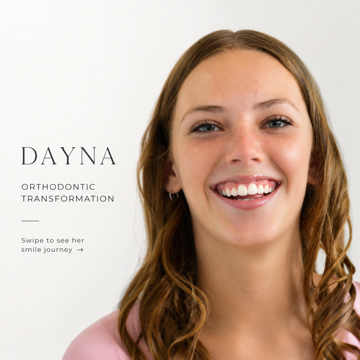 Featured image for “Orthodontic Treatment for Crowded Teeth | Dayna’s Smile Journey”
