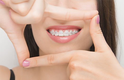 braces cleaning tips