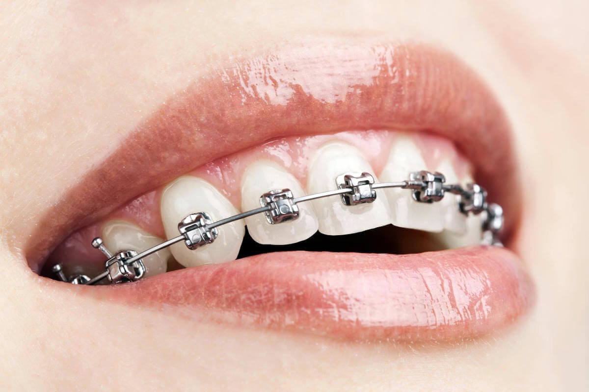 conventional braces