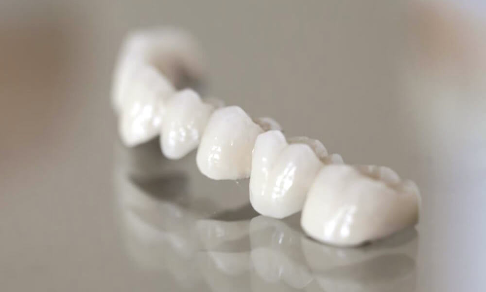 Dental crowns and bridges