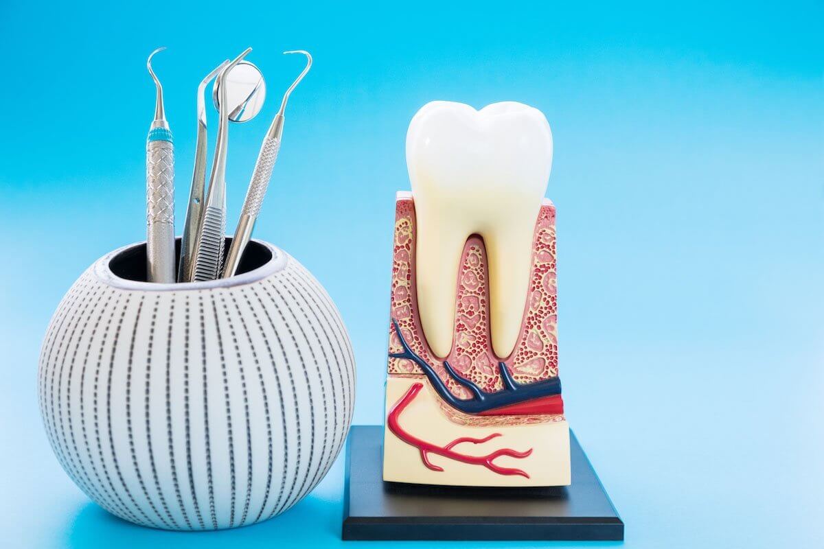 root canal therapy
