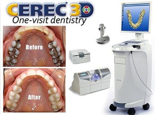 same day cerec crowns tech