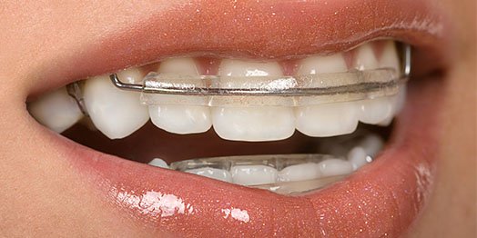 the benefit of retainers